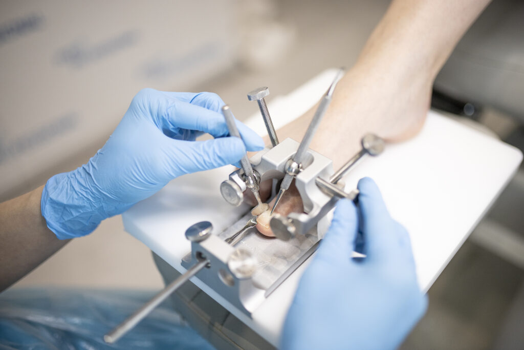 podologia - wrastający paznokieć